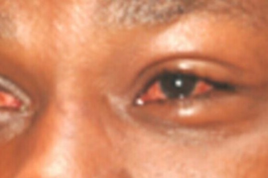 Red eye disease affects 800 in Leer-Sudan