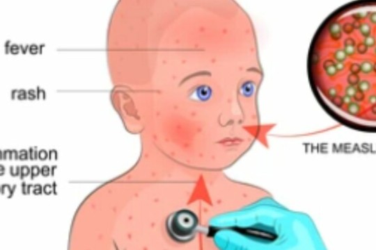 W. Bahr el Ghazal State Health Ministry records 194 measles cases-Sudan