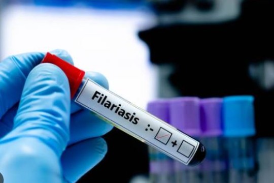 Over 62,000 to receive elephantiasis, river blindness drugs in Awerial County-Sudan