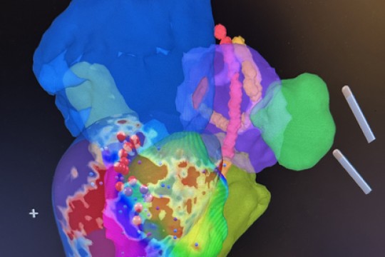 First in Human Ischemic VT Ablation Successfully Performed in iCMR